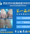 牛皮癣的初期症状