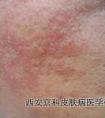 牛皮癣症状和图片