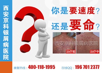 郑州市银屑病研究所治疗牛皮癣得多少钱
